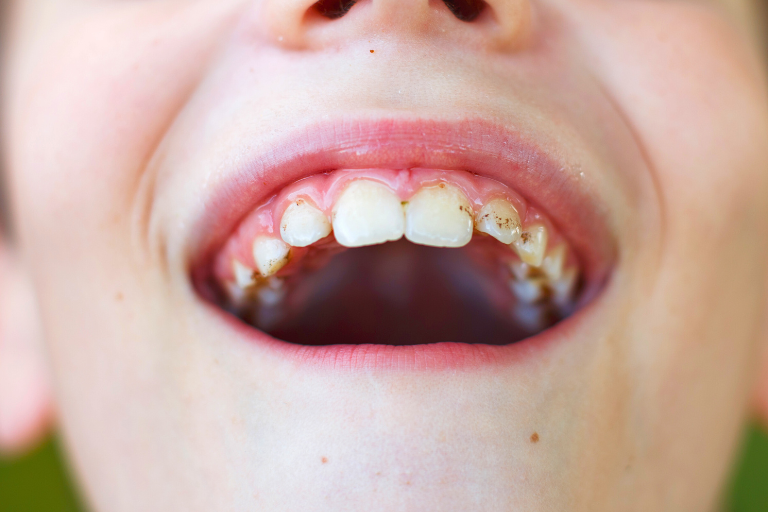 Relación de la presencia de caries dental y placa bacteriana en niños con la situación socioeconómica y cultural de sus familias